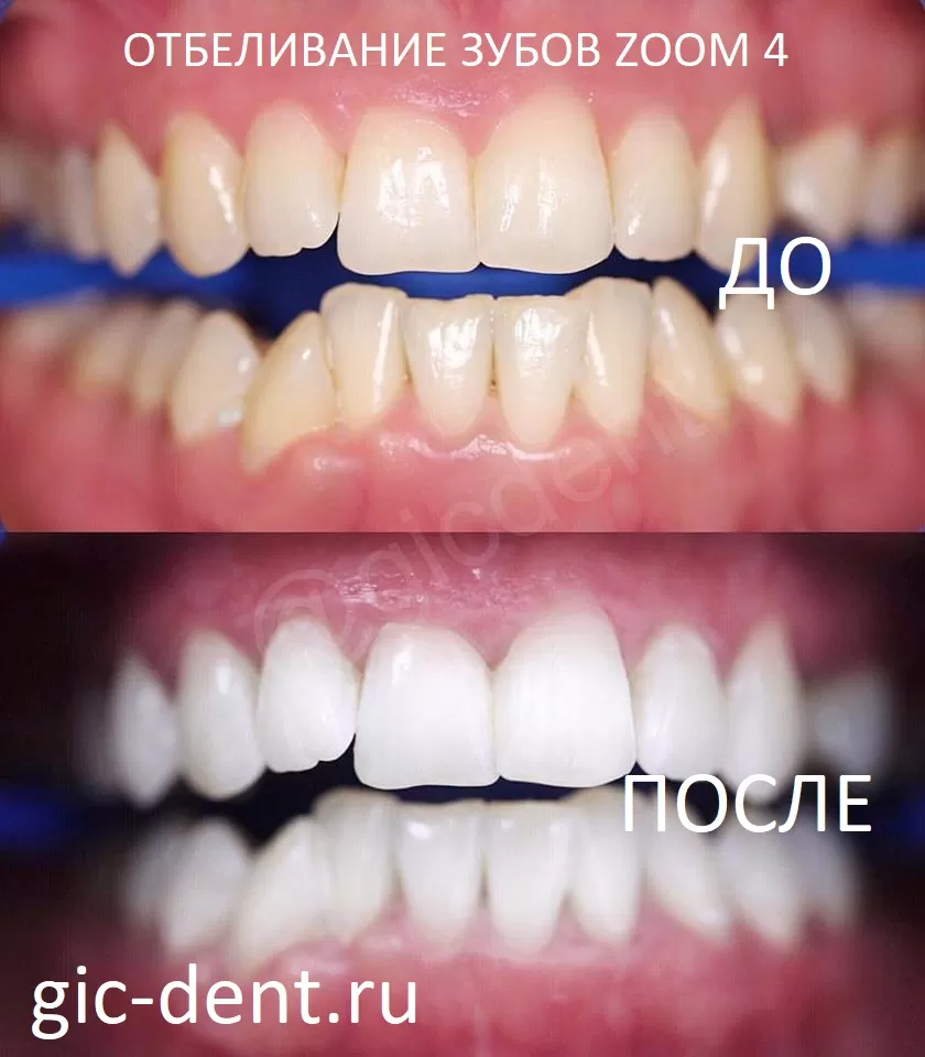 Отбеливание зубов время